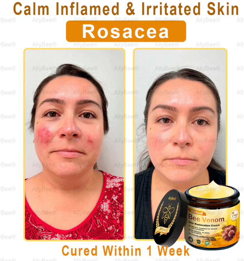 Mayo Clinic Official: AllyBee® Skin Treatment Cream Anti-aging, Hydrating, Skin Repair, Even Tone, Acne and Dark Spot Treatment, Wart and Mole Removal, Psoriasis Relief